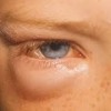 目の下の腫れの原因は？痛みやかゆみの症状はどの病気？